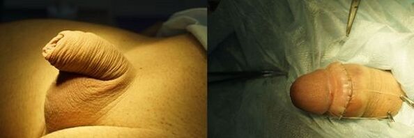 penis prije i poslije operacije povećanja