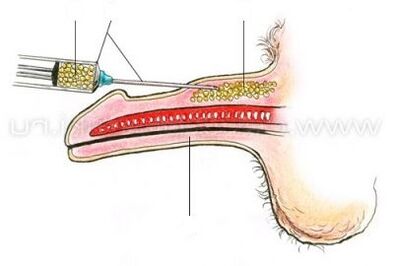 injekcijsko povećanje penisa